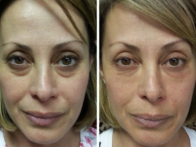 Tox to erase wrinkles